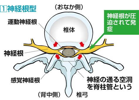 腰部脊柱管狭窄症とは？（ 原因や治療法など）大学病院やクリニックの医師7人の解説まとめ｜カラダネ