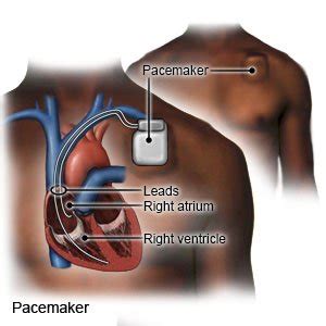 Pacemaker Types And Function