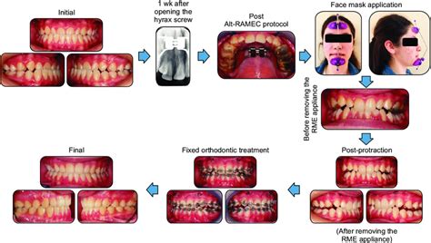 Treatment Stages Alt Ramec Alternate Rapid Maxillary Expansion And