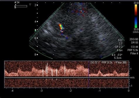 Transcranial Doppler Ultrasonography Should It Be The First Choice For