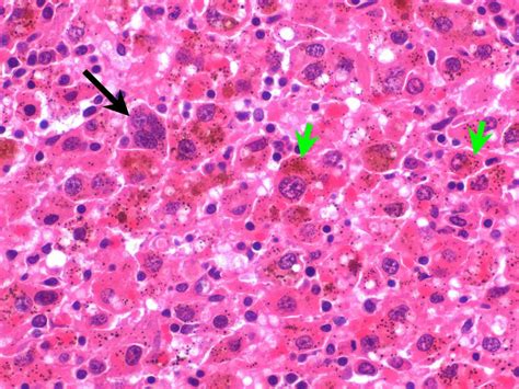 Haemophagocytic histiocytic sarcoma | Case Study | Cytopath