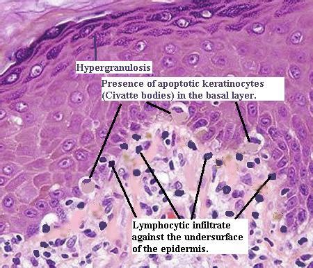 Medicine Decoded: Lichen planus