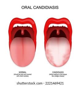 Healthy Tongue Color