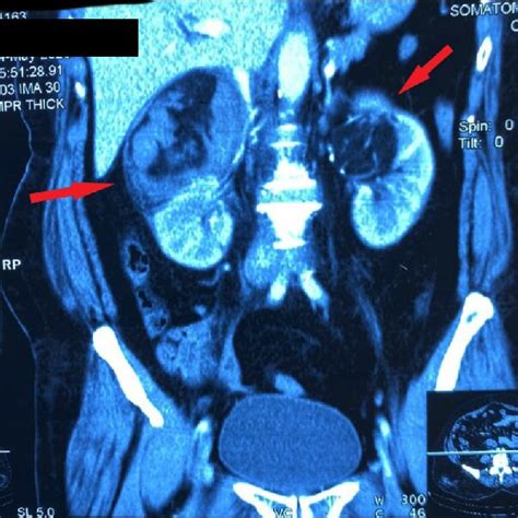 Computed Tomography Image Of Bilateral Renal Angiomyolipoma Download