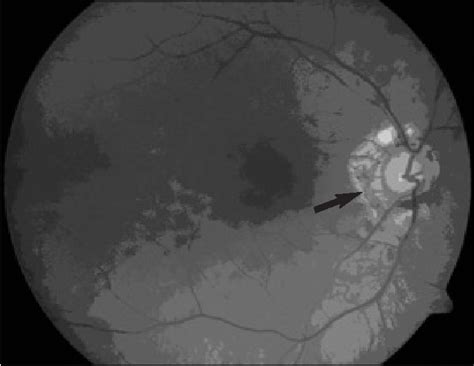 Figure 1 From Surgical Management Of Optic Disc Pit Associated Maculopathy Semantic Scholar