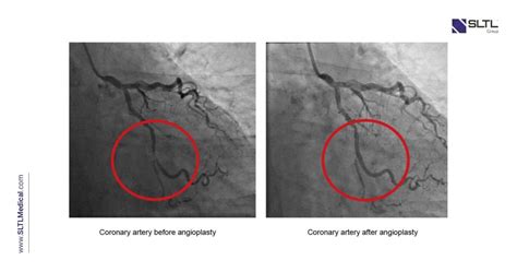 Everything You Need To Know About Angioplasty Sltl Group®