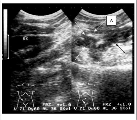 Figure 2 from Ultrasound-Guided Percutaneous Drainage of Abdominal ...