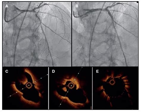 Orbital Atherectomy For Calcified Nodule Optical Coherence Tomography