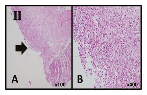 Histological Sections Of Colonic Mucosa In Case And Control Groups A