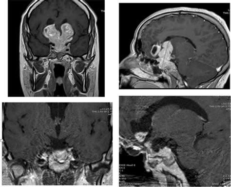 Prolactinoma Surgery