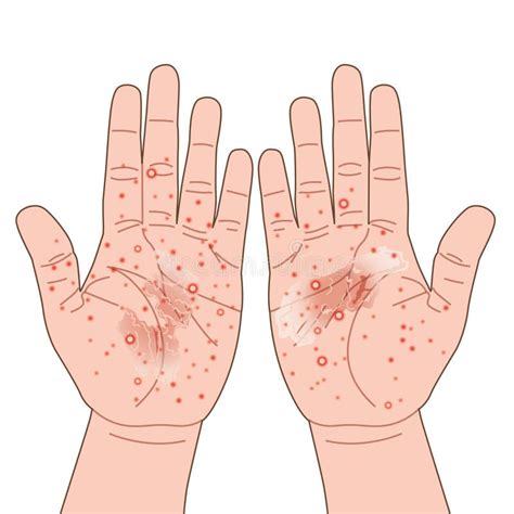 Eczema Or Allergy Rash Red On Hand Itching Urticaria Or Atopic