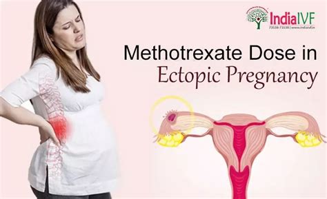 Methotrexate Dose in Ectopic Pregnancy - India IVF Fertility