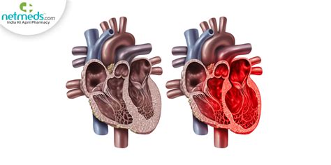 Broken Heart Syndrome Takotsubo Cardiomyopathy Causes Symptoms And