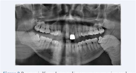 Figure 1 From A Giant Submandibular Sialolith In The Setting Of Chronic