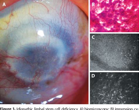 Figure From Impression Cytology And In Vivo Confocal Microscopy In