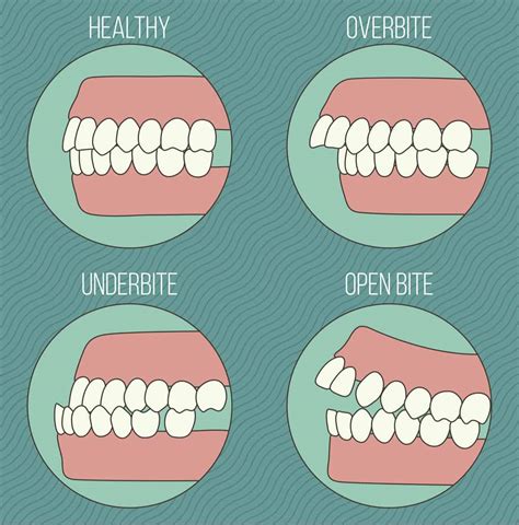 What Does Occlusion Mean In Orthodontics Archwired