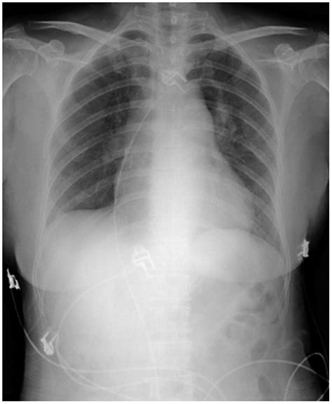 Chest X Ray Sitting Position Shows Prominent Right Hilum And Download Scientific Diagram