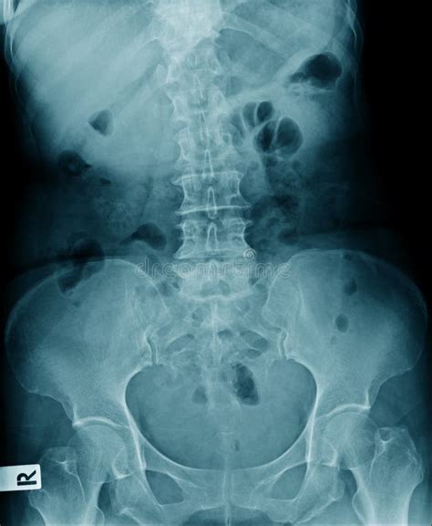 Imagen De Rayos X Columna Lumbar Y Cambio Degenerativo De Columna