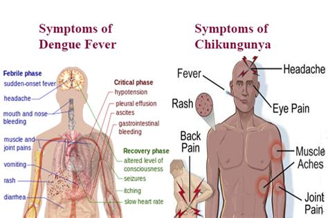 Dengue Vs Chikungunya Archives Microbiology Notes