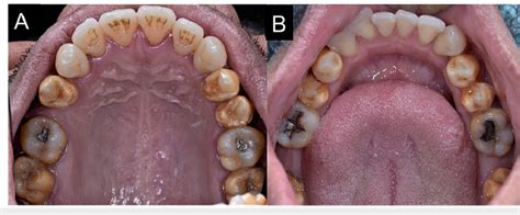 Intraoral Maxillary Occlusal View Of Discolored Premolar Teeth With