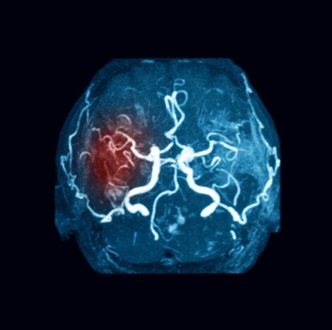 Embolia cerebral síntomas tipos y causas Mejor con Salud