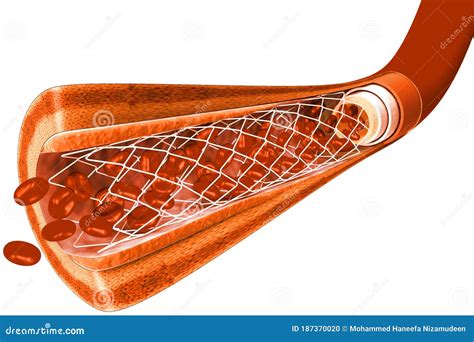 Stent angioplasty stock illustration. Illustration of cells - 187370020