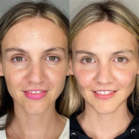 Sculptra Before And After Transforming Your Appearance With Long Lasting Results Must Read