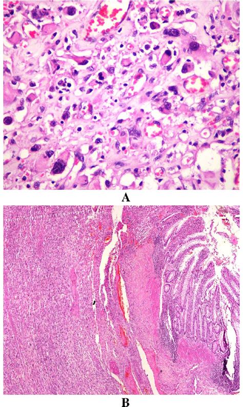 A Histopathologic Examination Showing Sheets Of Tumor Cells With Marked