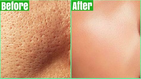 How To Get Rid Of Large Pores Permanently Works Shrink Get