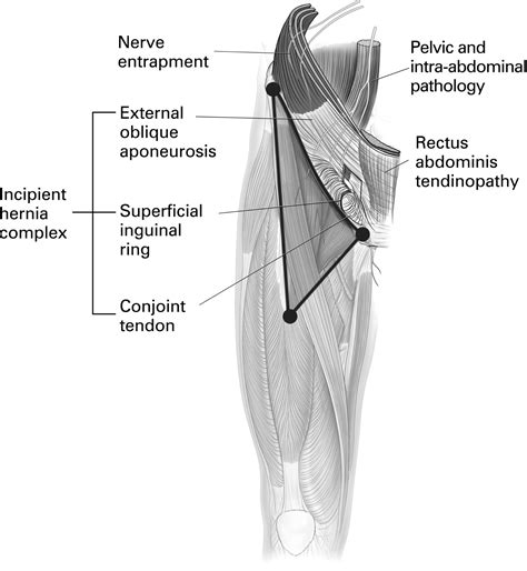 The Groin Triangle A Patho Anatomical Approach To The Diagnosis Of