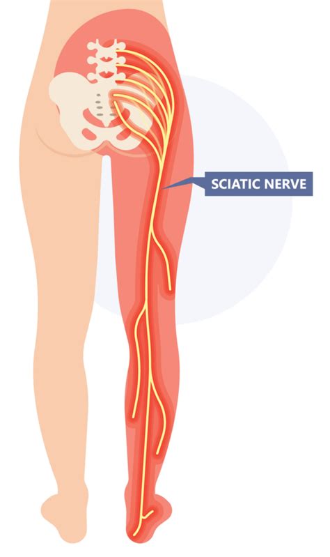 Sciatica Foundation Therapy