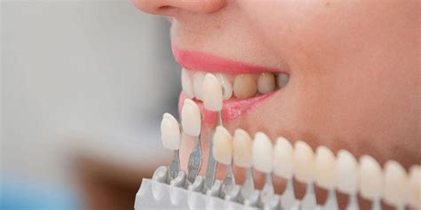 Benefícios da lente de contato dental Clínica SiM