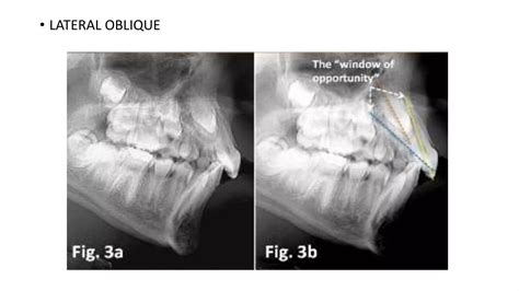 Radiographic Assessment Of Impacted Teeth Ppt