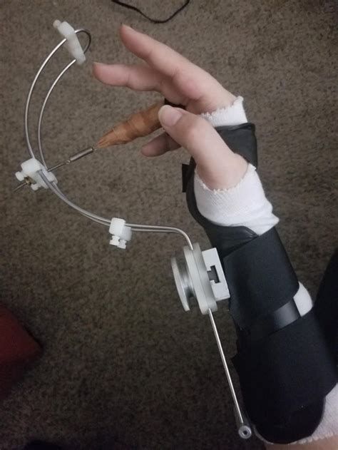 Traction splint for my dislocated and fractured finger : r/specializedtools