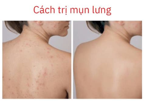 Triệu Chứng Và Cách điều Trị Mụn Lưng Sưng để Nhận Biết Và Khắc Phục