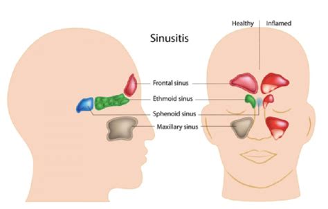 Sinusitis Penyebab Gejala Dan Pencegahannya Dinas Kesehatan