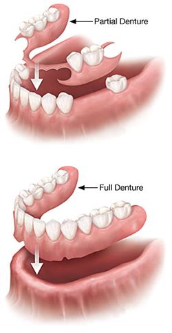 Claspless Partial Dentures