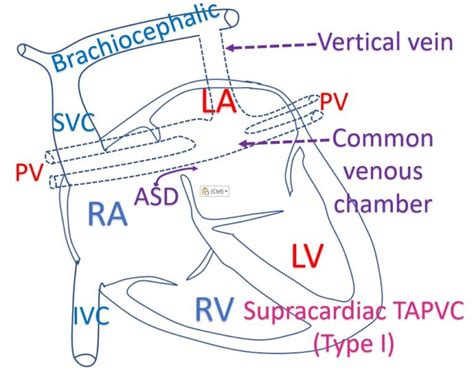 Classification of TAPVC – All About Cardiovascular System and Disorders