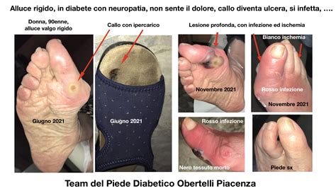 Piede Diabetico Dr Fabio Granata Podologo Infermiere Esperto In