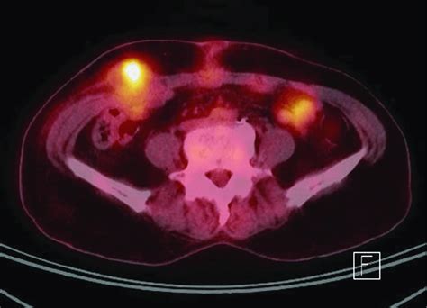 Positron Emission Tomography Computed Tomography Shows Abnormal