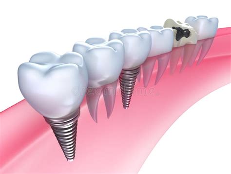 Dental Implants In The Gum Stock Illustration Illustration Of Metal