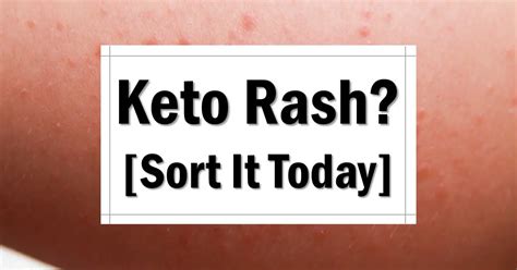 Keto Rash Explained [plus How To Treat A Keto Rash] The Keto Eater