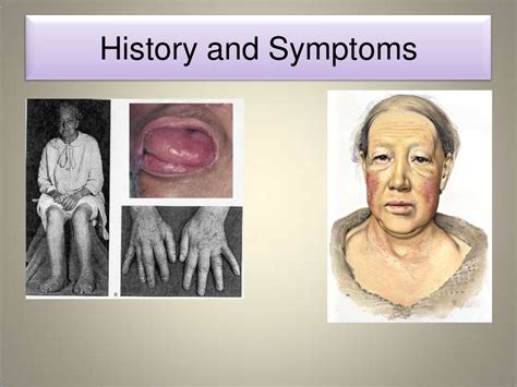 Myxedema And Hypothyroid