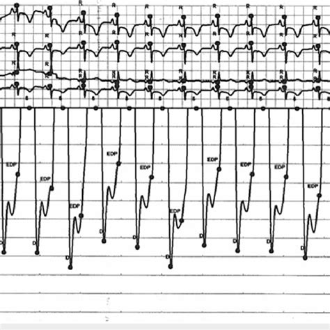 Left Ventricular End Diastolic Pressure Tracing Download Scientific