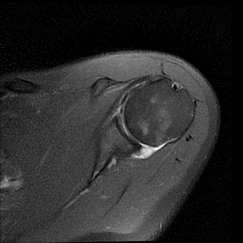 Osteonecrosis Of The Humeral Head Image