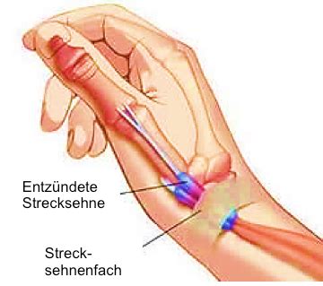 Tendovaginitis de Quervain OCP Praxis Münster