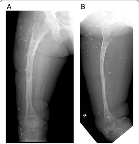 Anterolateral A And Lateral B Radiographs Taken 24 Months After The