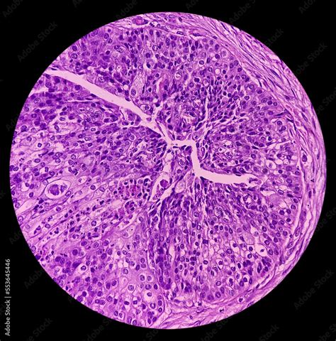 Foto De High Grade Mucoepidermoid Carcinoma Of Parotid Cyst