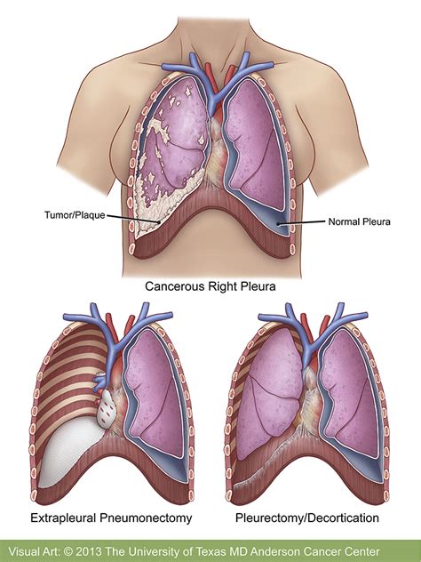 Mesothelioma Treatment Md Anderson Cancer Center