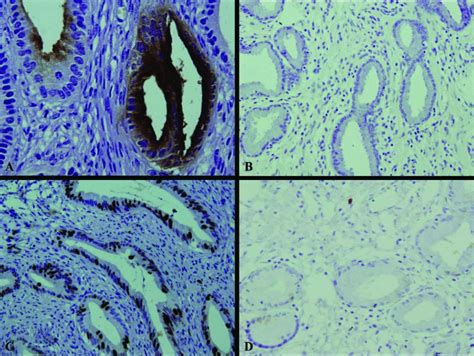 Clonal Status And Clinicopathological Observation Of Cervical Minimal